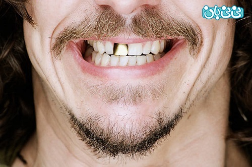 روش های صاف کردن دندان بدون ارتودنسی چیست؟