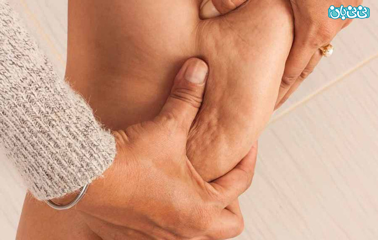 درباره درمان سلولیت ران و بازو و شکم با اندولیفت چه می‌دانید؟