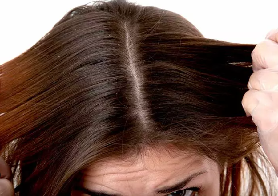 علت خشکی پوست سر چیست و چگونه آن را درمان کنیم؟ علت خشکی پوست سر چیست و چگونه آن را درمان کنیم؟