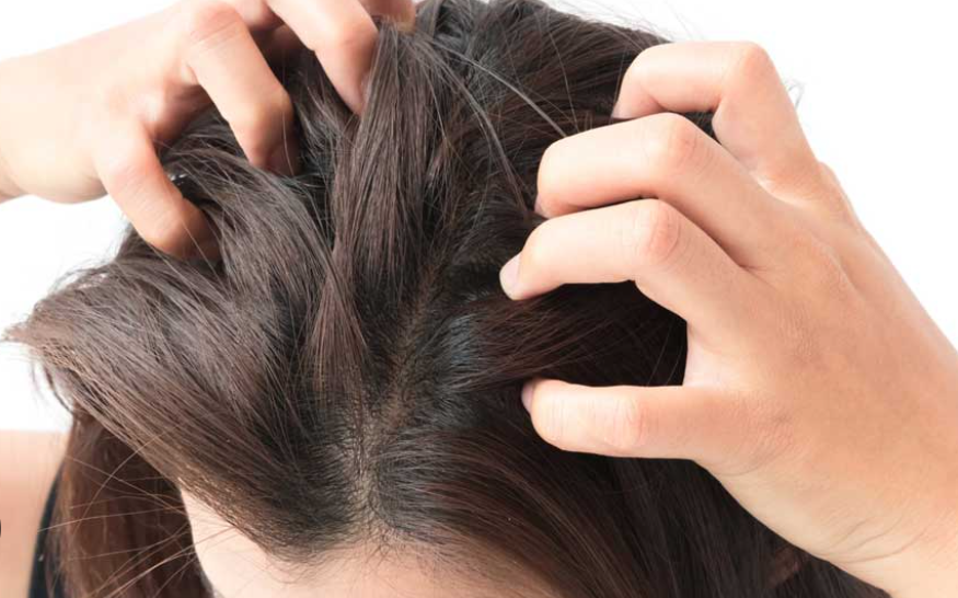 علت خشکی پوست سر چیست و چگونه آن را درمان کنیم؟ علت خشکی پوست سر چیست و چگونه آن را درمان کنیم؟
