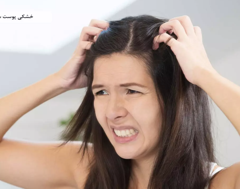 علت خشکی پوست سر چیست و چگونه آن را درمان کنیم؟ علت خشکی پوست سر چیست و چگونه آن را درمان کنیم؟
