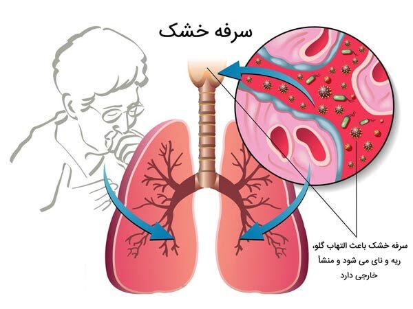 علت ایجاد سرفه چیست + ۵ راهکار درمان خانگی