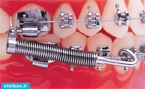 قیمت ارتودنسی در ایران