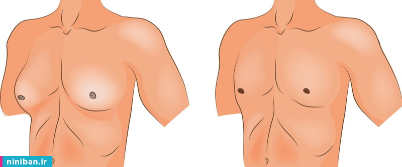 هزینه درمان ژنیکوماستی در مردان چقدر است؟