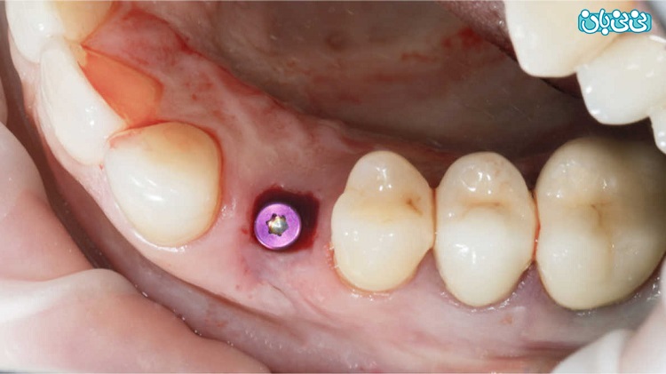 ایمپلنت دندان دیابتی ها، خطرناک یا بی‌خطر؟