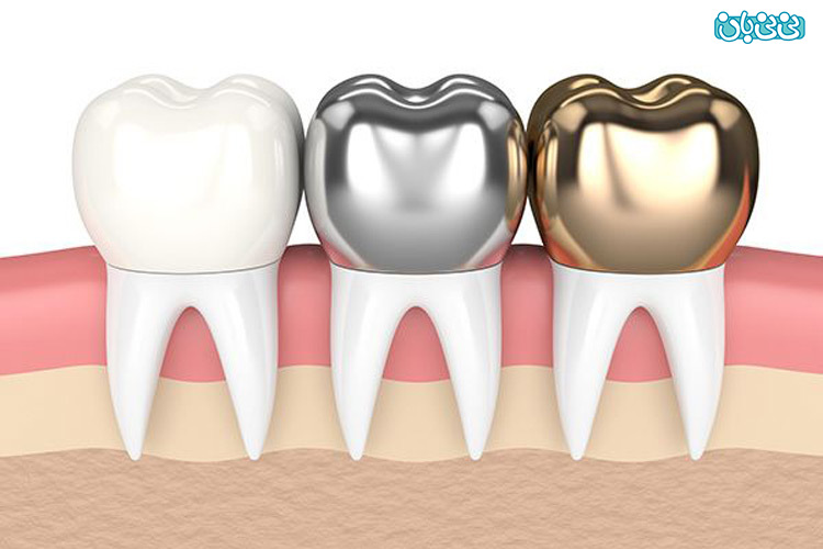 همه چیز درباره روکش دندان