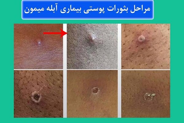 طول مدت بروز و بهبودی بیماری آبله میمونی/واکسیناسیون افراد پرخطر