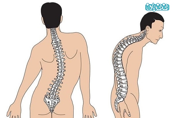 درمان اختلالات انحنای ستون فقرات