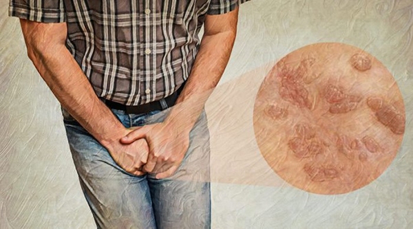 زگیل تناسلی یا HPV و روش تشخیص آن در مردان و زنان