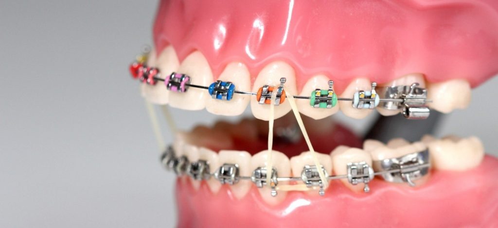 آیا با اصطلاحات ارتودنسی دندان آشنا هستید؟