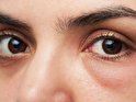 روش‌هایی موثر برای از بین بردن پف چشم