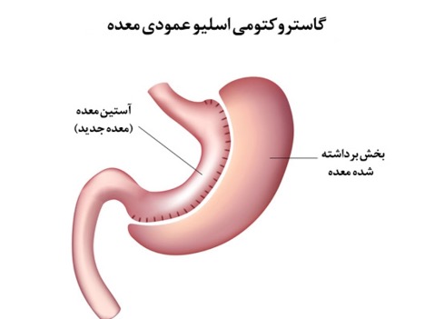 آیا با عوارض عمل اسلیو معده آشنا هستید؟ (یک پزشک)