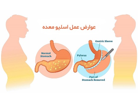 آیا با عوارض عمل اسلیو معده آشنا هستید؟ (یک پزشک)