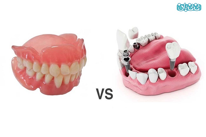 پروتز دندان بهتر است یا ایمپلنت؟