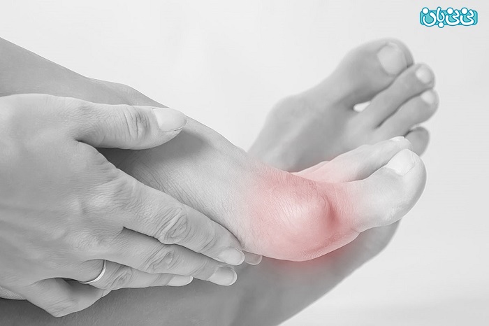هالوکس والگوس شست پا چیست و چگونه درمان می‌شود؟