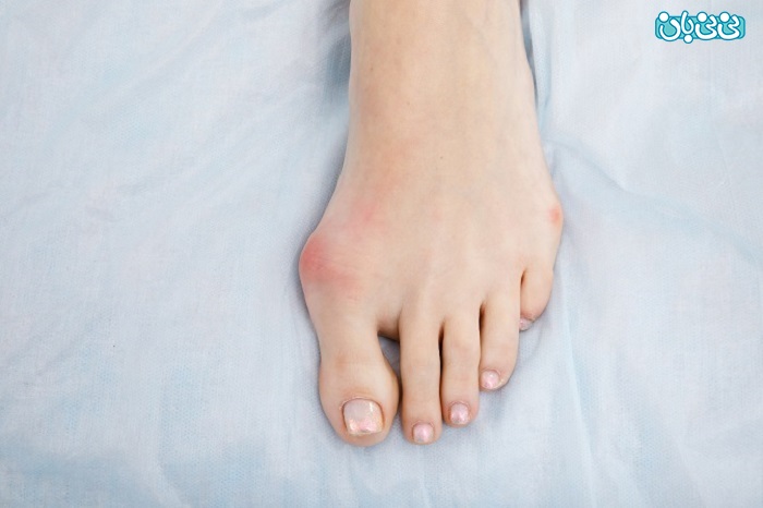 هالوکس والگوس شست پا چیست و چگونه درمان می‌شود؟