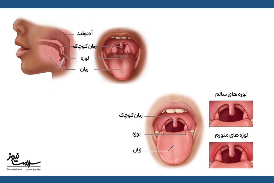 تورم لوزه ها