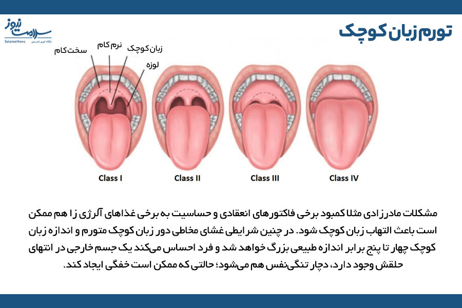 تورم زبان کوچک