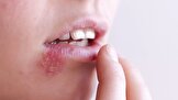 عفونت تبخال میتواند خطر زوال عقل را در افراد مسن دوبرابر کند